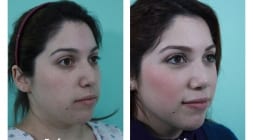 Female Rhinoplasty