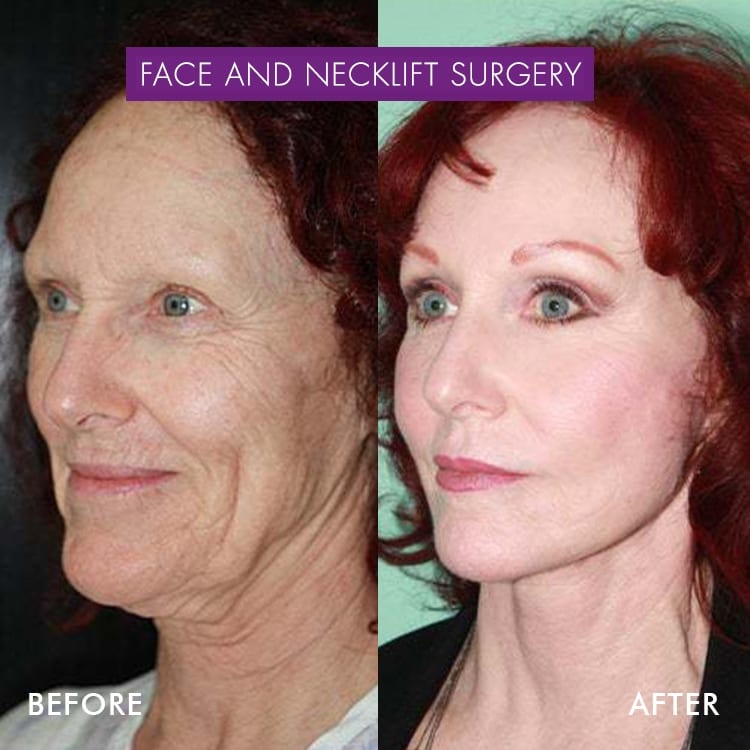Facelift, Cosmetic Surgery