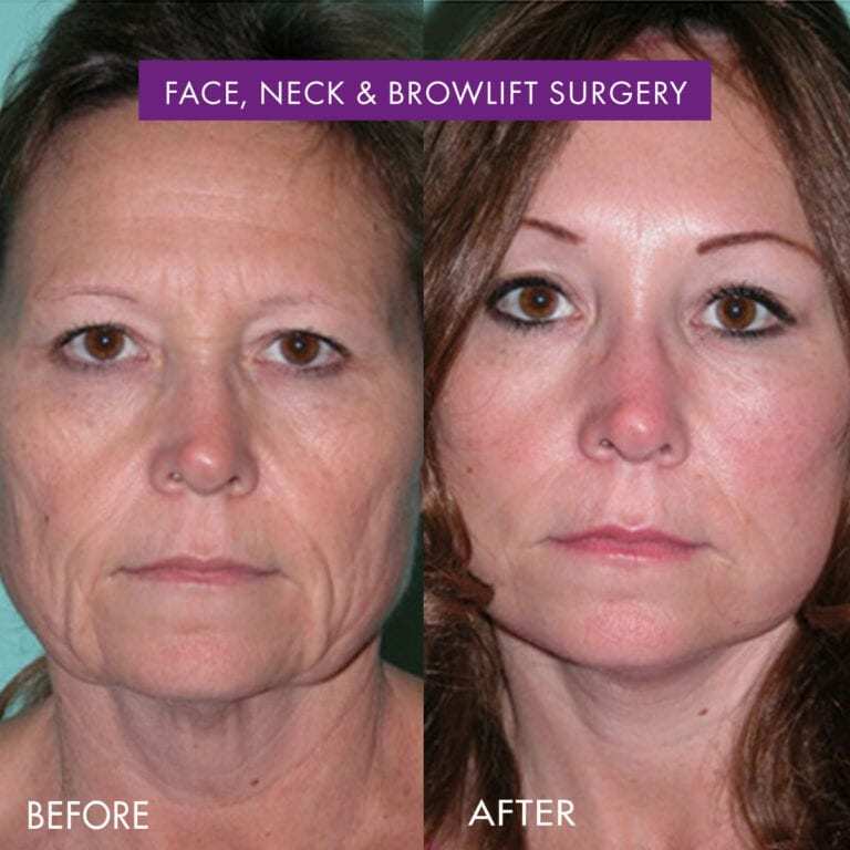 Facelift Mexico: Face Lift Surgery Cost, Procedure & Recovery | Vida